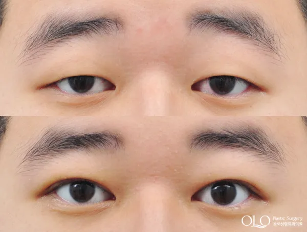 Before
