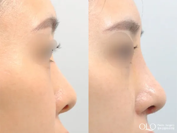 Before/After