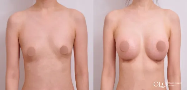 Before/After