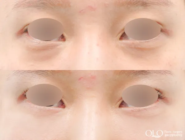 Before/After