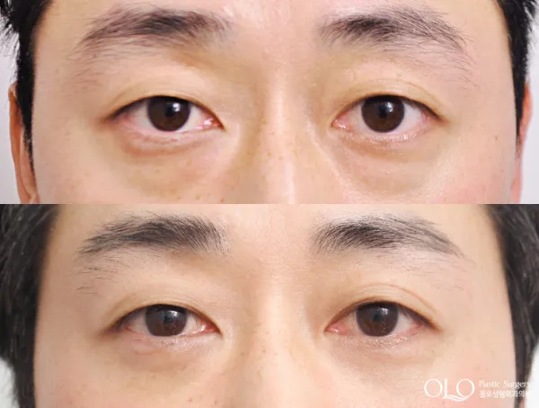 Before/After