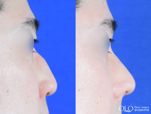 Before/After