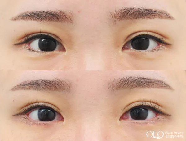 Before/After
