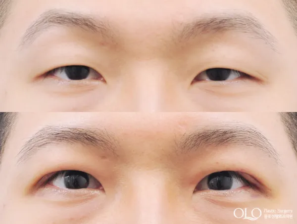 Before/After