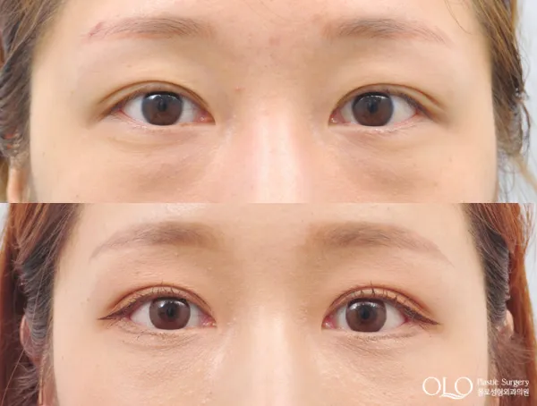 Before/After