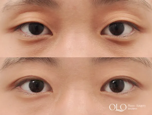 Before