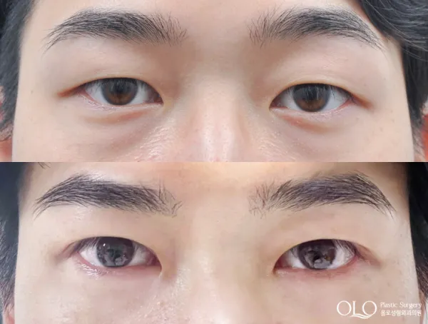 Before/After