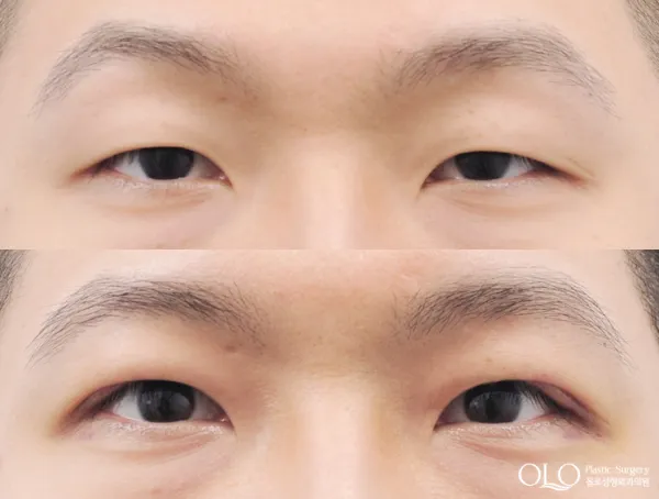 Before/After