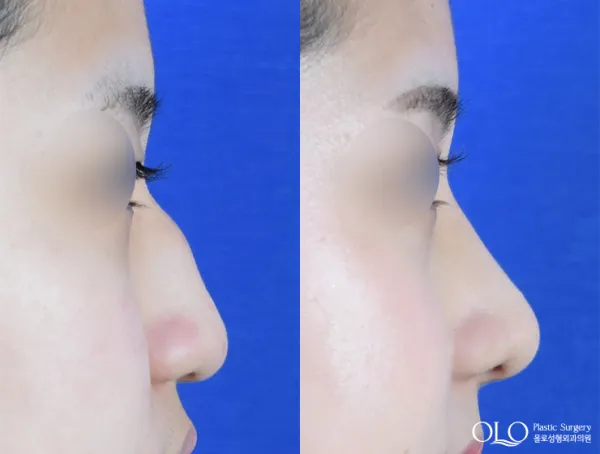 Before/After