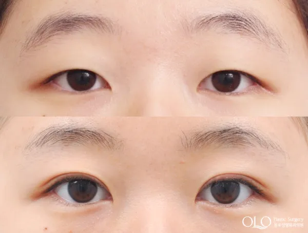 Before/After
