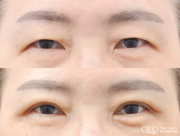 Before/After