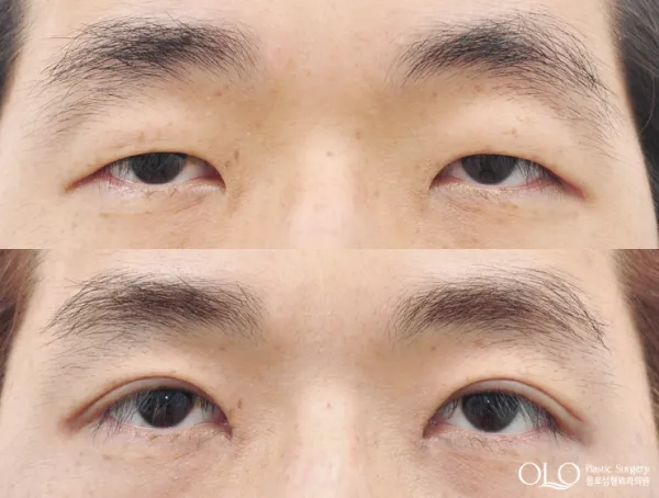 Before/After
