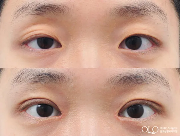 Before/After