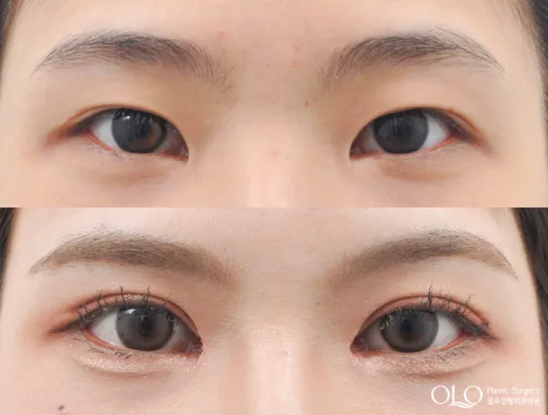 Before/After