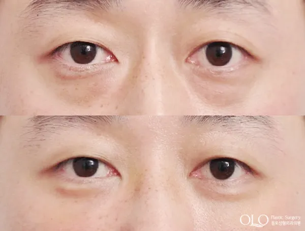 Before/After