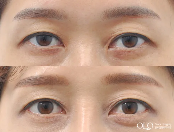 Before/After