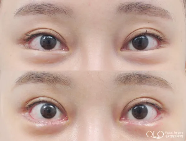 Before/After
