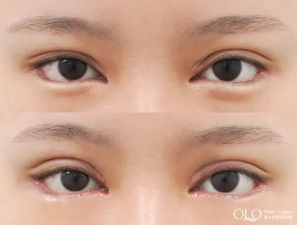Before/After