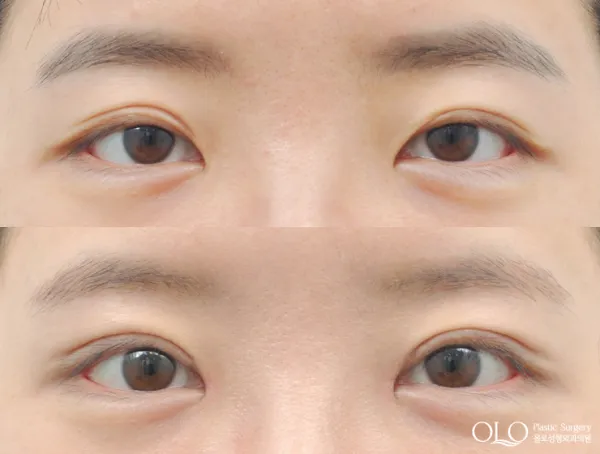 Before/After