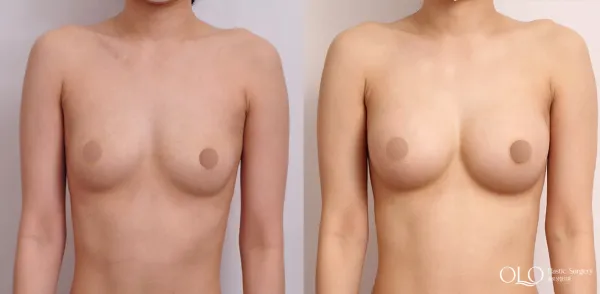 Before/After