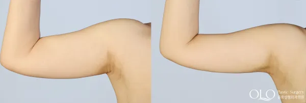 Before/After