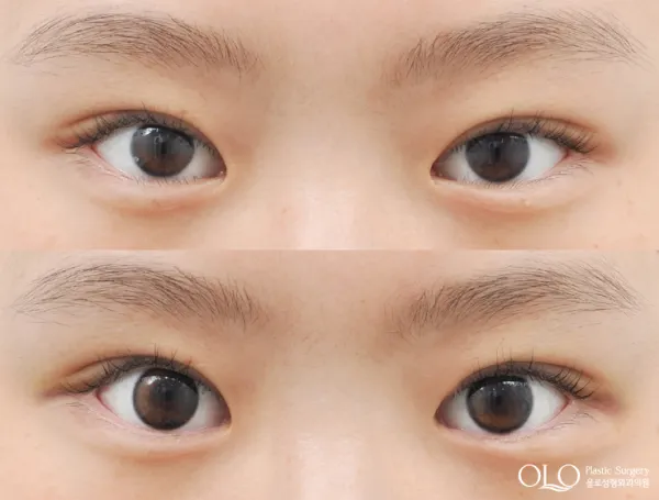 Before/After