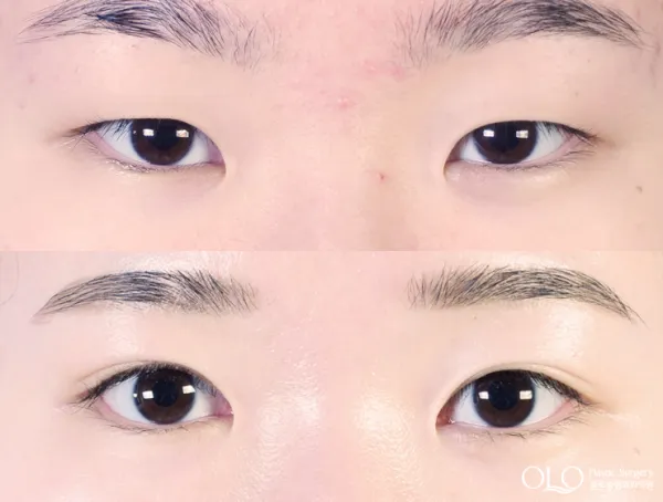 Before/After