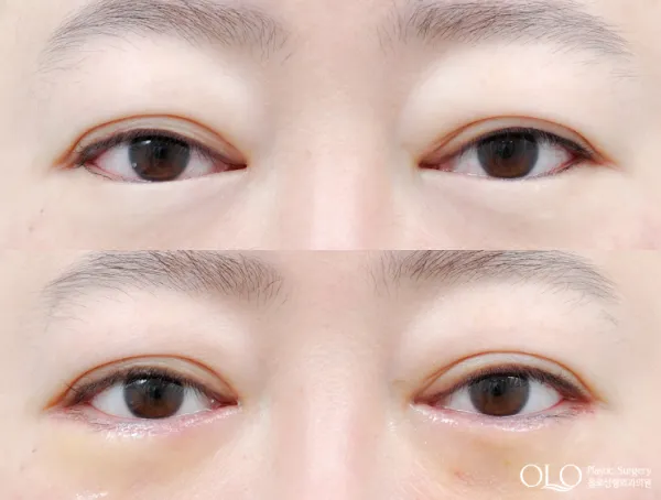 Before/After