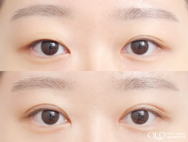 Before/After