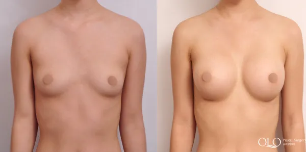 Before/After