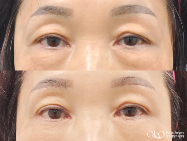 Before/After