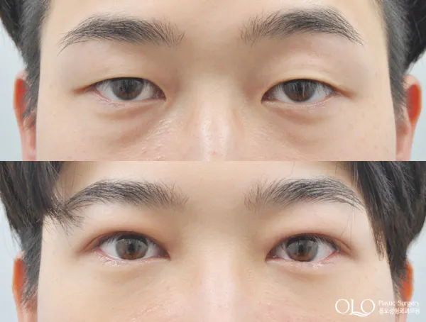 Before/After