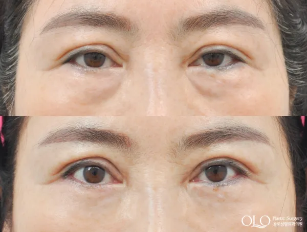 Before/After