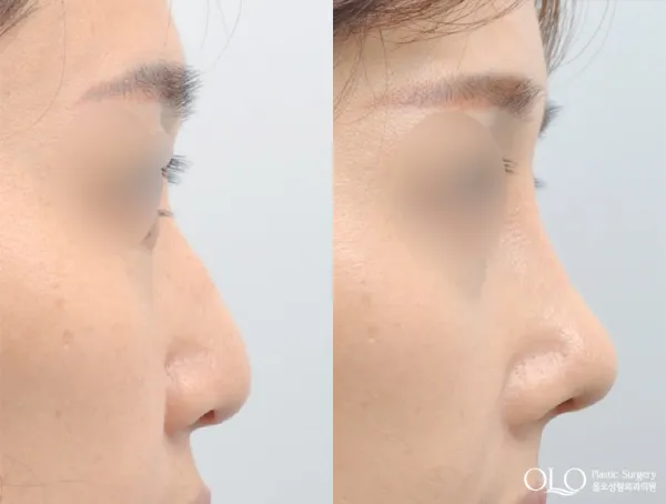 Before/After