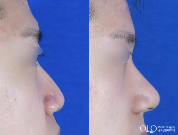 Before/After