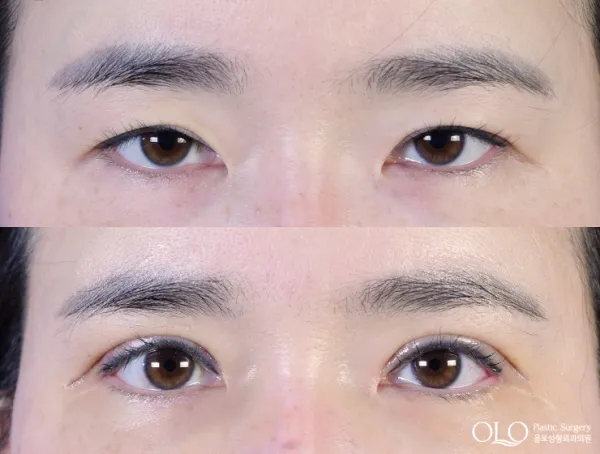 Before/After