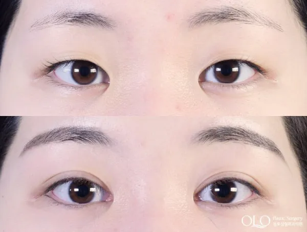 Before/After