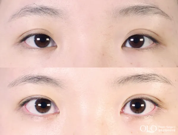 Before/After