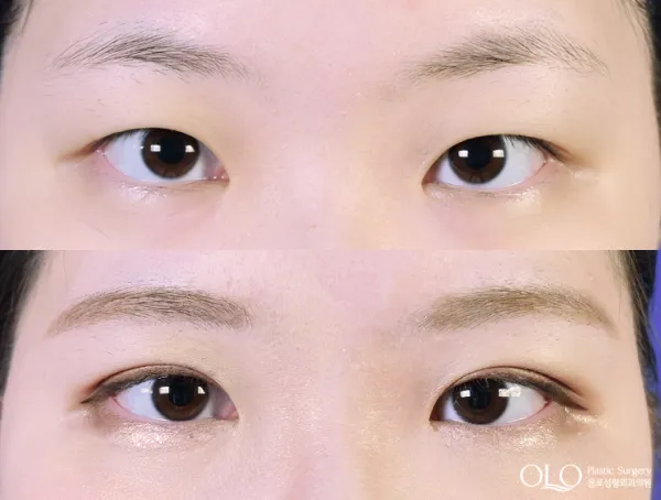 Before/After