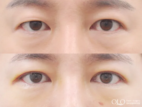 Before/After