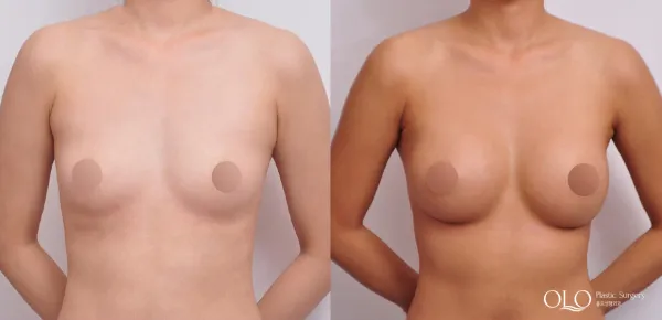 Before/After