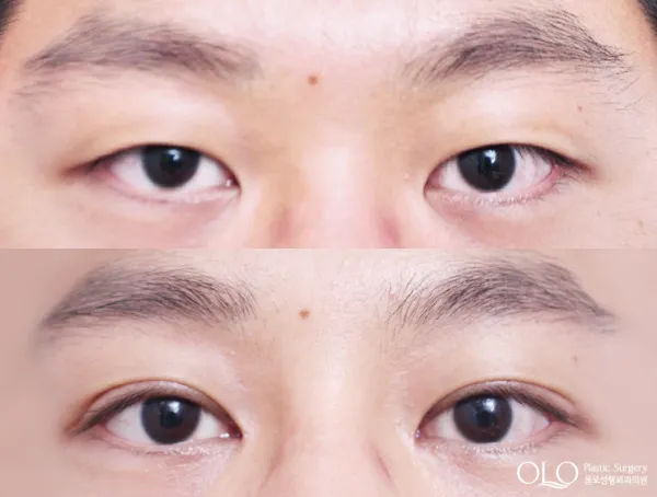 Before/After