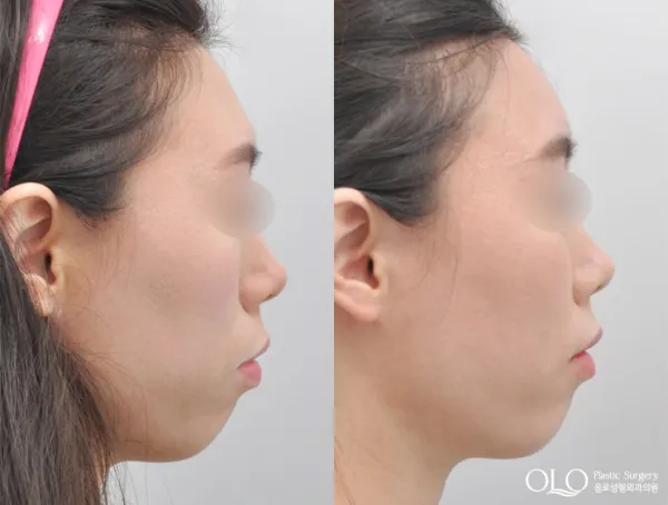 Before/After