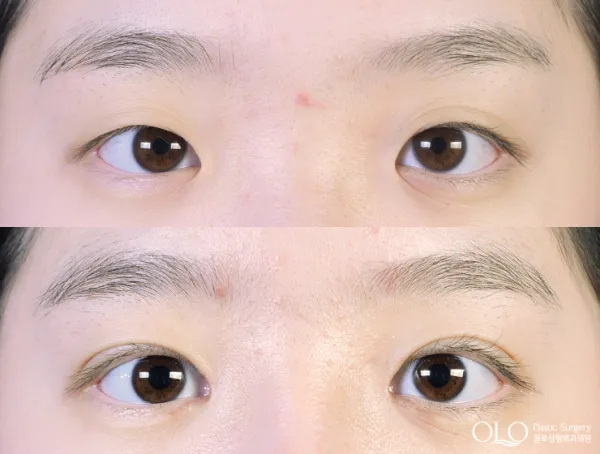 Before/After
