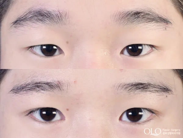 Before/After