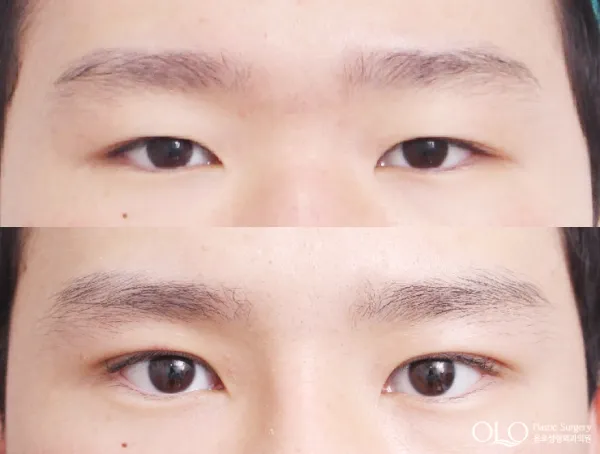 Before/After