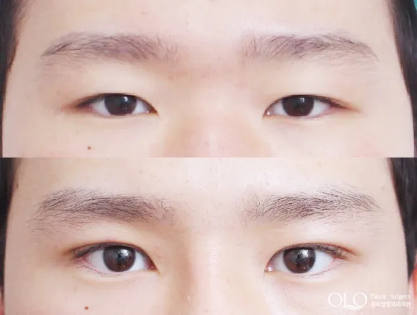 Before/After