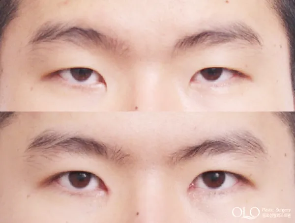 Before/After