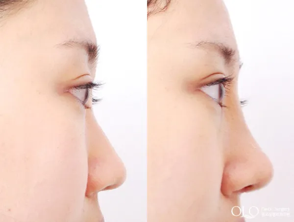 Before/After