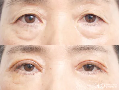 Before & After